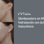 Skinboosters en Marín: hidratación con ácido hialurónico