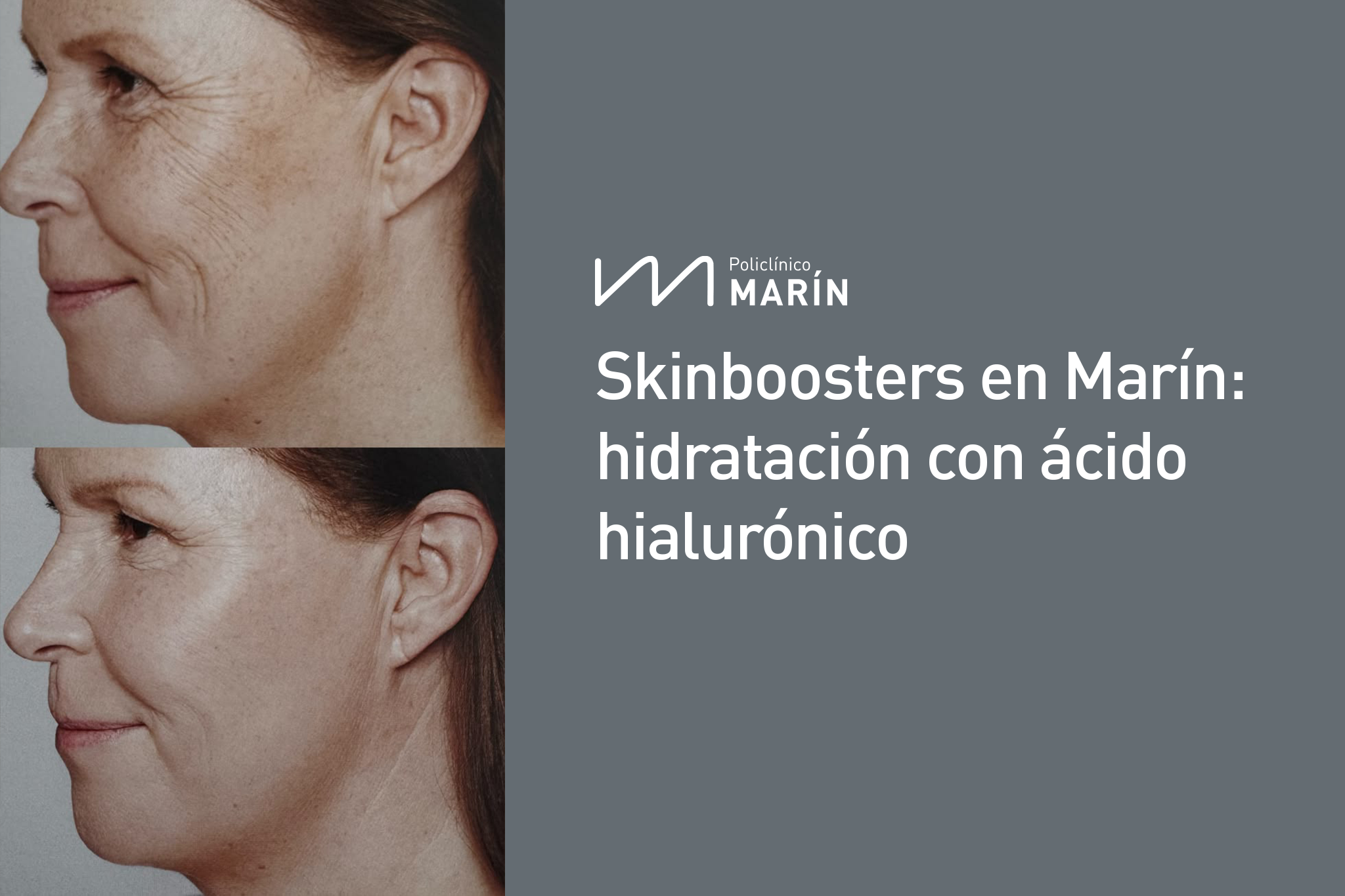 skinboosters-en-marin-medicina-estética